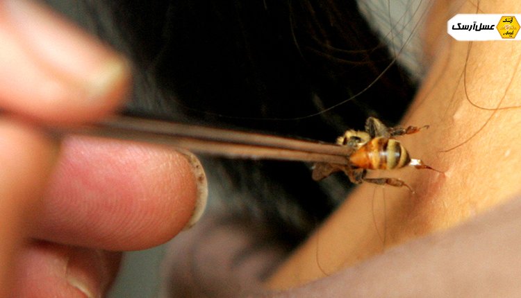 تکنیک های کاربرد زهر زنبور عسل
